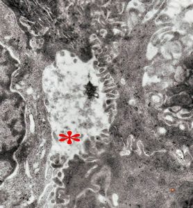 F,7m. | giant cell hepatitis* - dilated primary bile duct F,7m. | giant cell hepatitis* - dilated primary bile duct